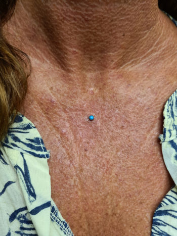 Microdermal with natural turquoise